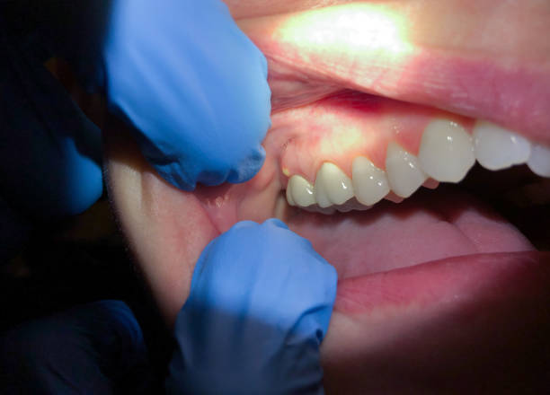 Best Emergency Root Canal Treatment in Horace, ND